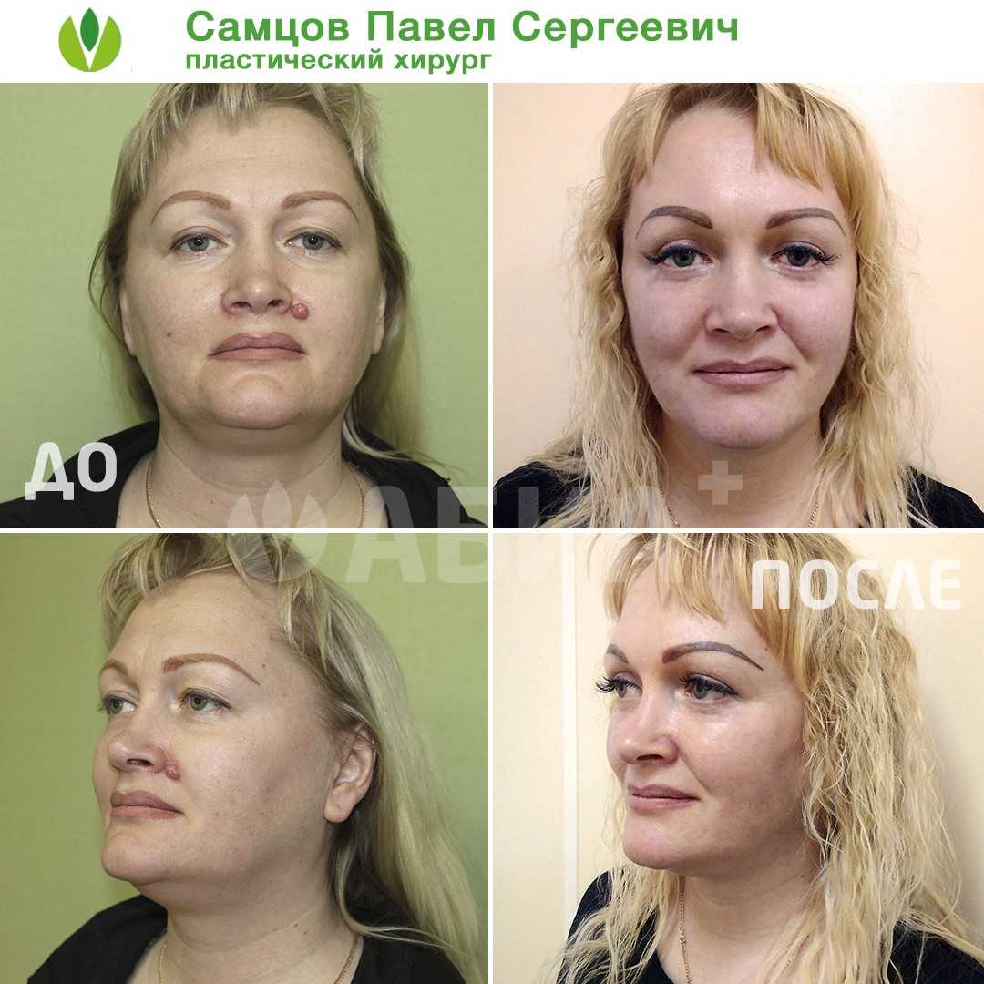 Каковы преимущества и риски липосакции?