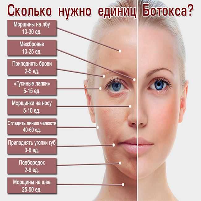 Коррекция кисетных морщин вокруг рта