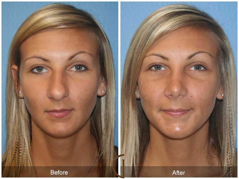 Фото ринопластики до и после нос. Ринопластика. Пластика носа. Нос до и после ринопластики.